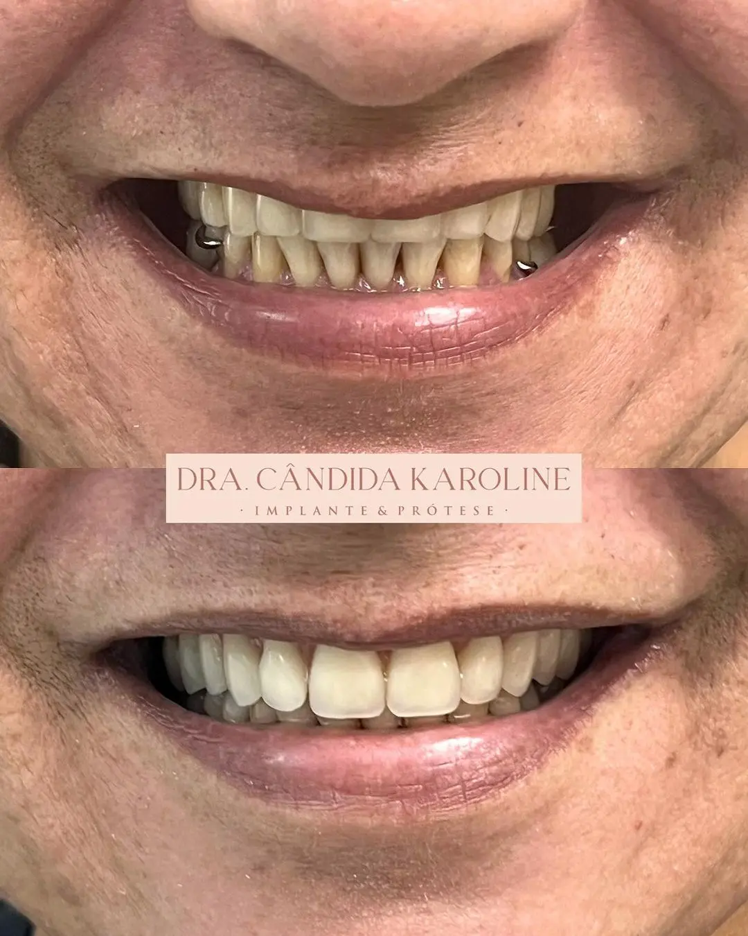 Sorriso restaurado em 1 sessão!